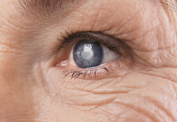 Woman's eye with cataract