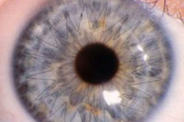 Corneal crosslink