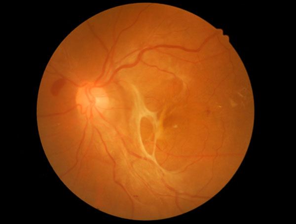 Medical photo tractional retinal detachment of diabetic
