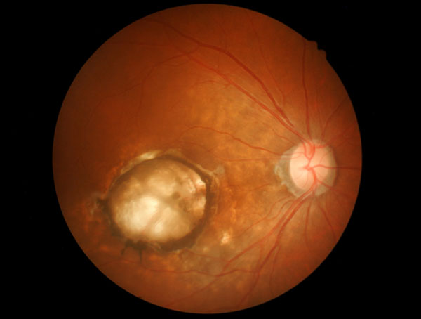 Medical photo Age-related macular degeneration (AMD)